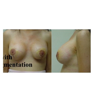 Breast Lift With Implants After